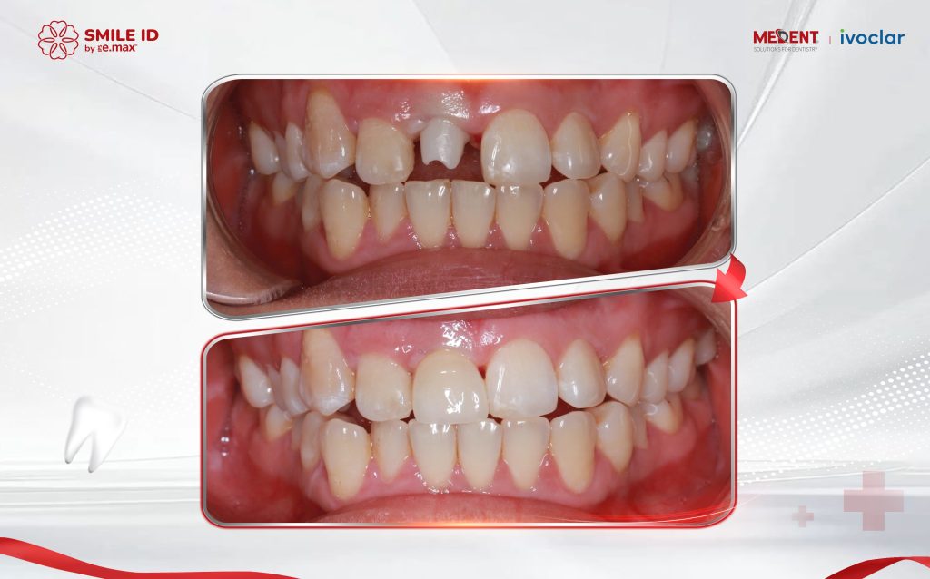 IPS e.max: Lời Giải Cho Hành Trình Tìm Kiếm Nụ Cười Tự Nhiên Bền Vững