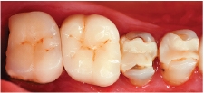 Hình 4: Phục hình bị hỏng ở khu vực răng sau đang rất cần sửa