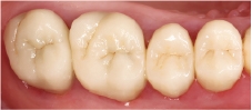 Hình 10: Kiểm tra mão răng vào năm 2012