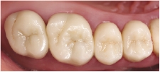 Hình 11: Tình trạng sau 10 năm (2017): Mão răng còn nguyên vẹn và không có dấu hiệu hư hỏng rõ rệt. Các cạnh mòn có thể thấy rõ, ví dụ: trên mũi phía gần-xa của răng trên bên trái 6.