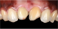 Hình 17: Kết quả là không đạt yêu cầu về mặt thẩm mỹ, răng đã được chuẩn bị bằng cách sử dụng quy trình xâm lấn tối thiểu.