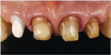 Hình 23: Sự biến đổi màu của cùi răng làm cho ta cần sử dụng một vật liệu tương đối mờ đục mà vẫn một hiệu ứng sáng đủ.