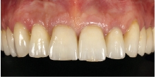 Hình 25: Các cùi răng đã được che giấu một cách hiệu quả dưới các mão răng mới (phương pháp cut-back) và độ sáng của răng đã tăng đáng kể.
