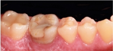 Hình 30: Răng dưới bên phải 6 đã được điều trị nội nha nhưng không thể cứu được vì các quá trình viêm tái phát.
