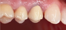 Hình 35: Răng đã được điều trị nội nha và phục hồi với mão PFM. Sau khi hư chân răng, nó không thể được bảo tồn nữa.